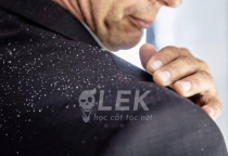 Gàu và cách điều trị gàu dành cho Nam giới